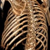 Kaburga Kırıkları