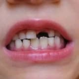 Süt dişleri neden önemlidir ?