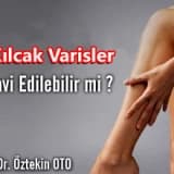 Kılcal varisler tedavi edilebilir mi?