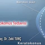 Keratokonüs tedavisi