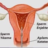 Aşılama ( İnrtauterin İnseminasyon ) Tedavisi Hangi Çiftlere Uygulanabilir ?