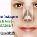 Septum Deviasyonu ( Burunda Kemik - Kıkırdak Eğriliği ) 