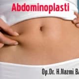 Abdominoplasti