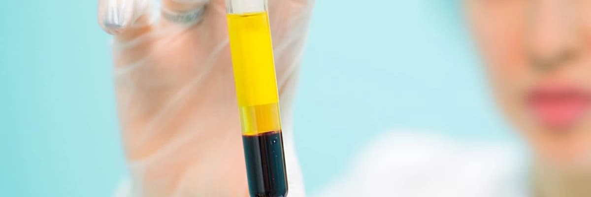 PRP (Platelet Rich Plasma)