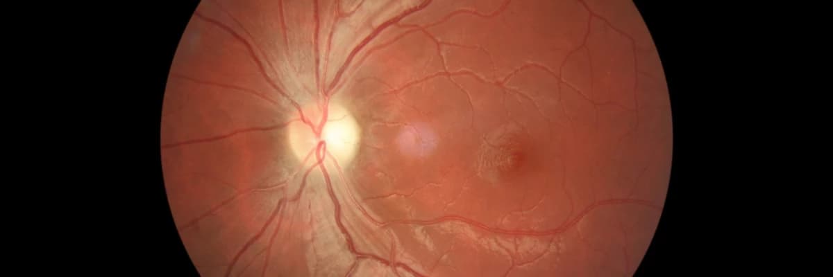 KALITIMSAL OPTİK SİNİR HASTALIKLARI ve Sebepleri