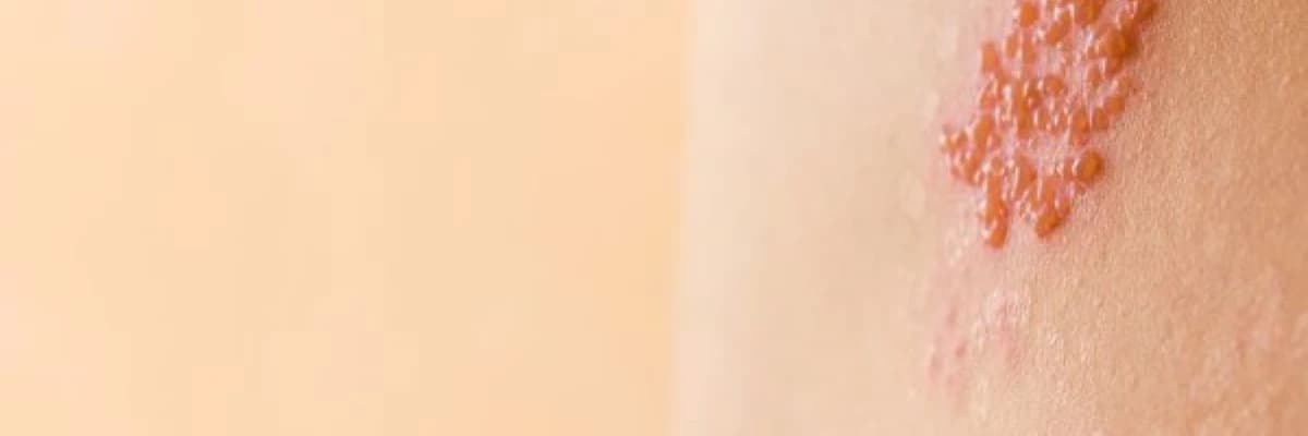 ZONA (HERPES ZOSTER)