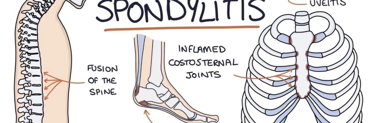 ANKİLOZAN SPONDİLİT HAKKINDA BİLİNMESİ GEREKENLER