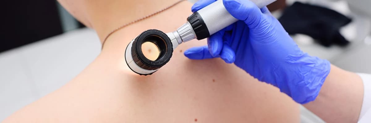 Deri Kanseri Tanı ve Tedavi Süreçleri Hakkında