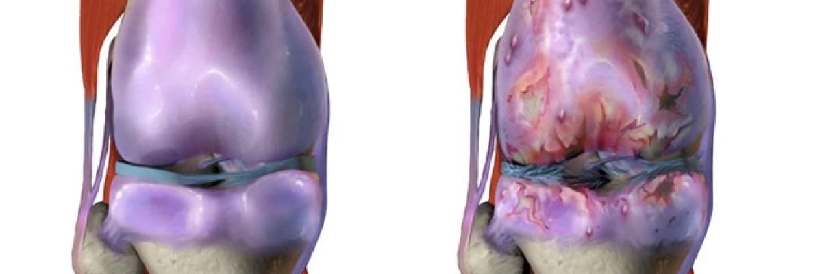 OSTEOARTRİT (EKLEM KİREÇLENMESİ)