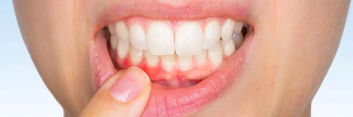 Diş Eti Kanamaları ve Oral Hijyenin Hayatımızdaki Önemi