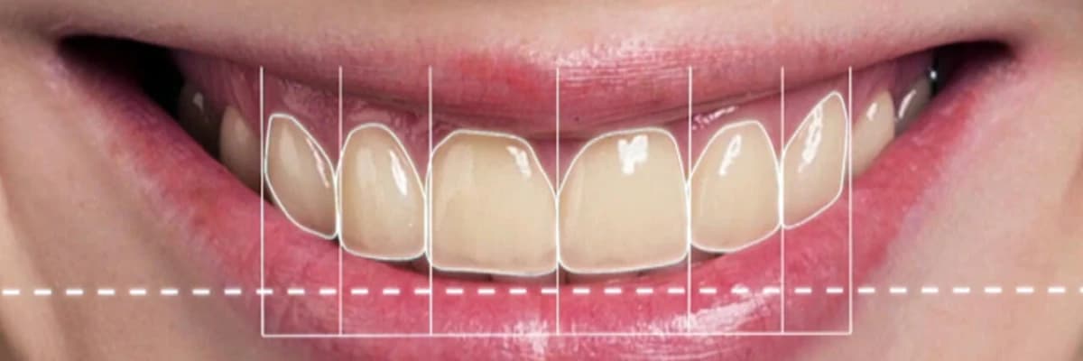 Kişisel Gülüş Tasarımı