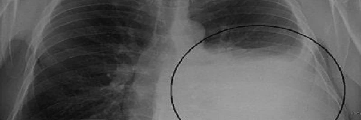 Plevral efüzyon nedir, nasıl belirti verir, nasıl tedavi edilir ?