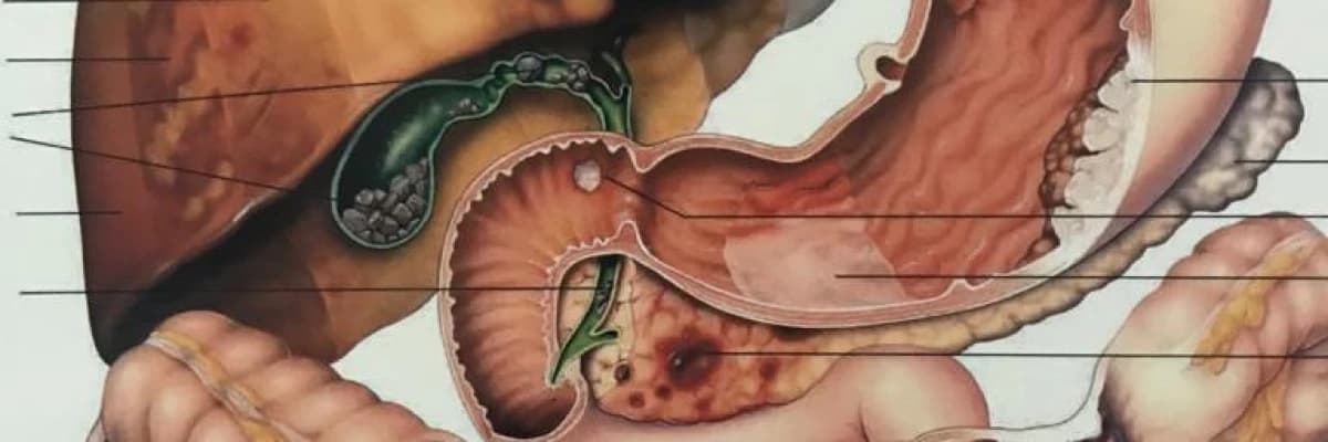 ERCP, safra kesesi ameliyatının alternatifi değildir"