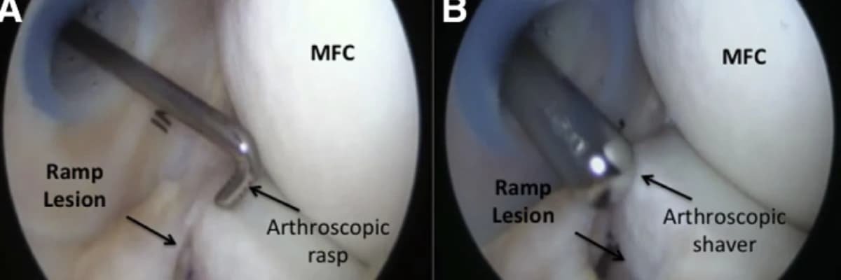 Meniscal ramp lesion repair by a trans‐septal portal technique