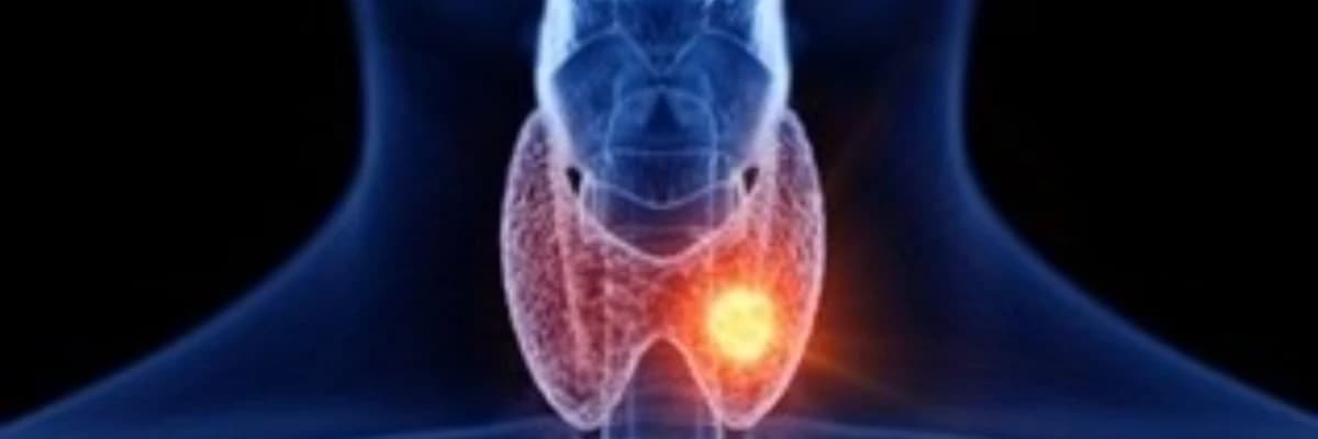 TİROİD NODÜLLERİ
