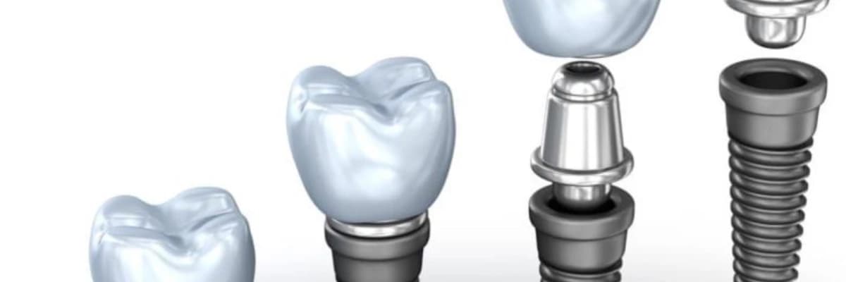 All on 4 Implant Tedavisi Nedir?
