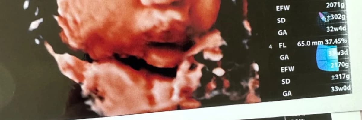 Dört boyutlu ultrasonoğrafi