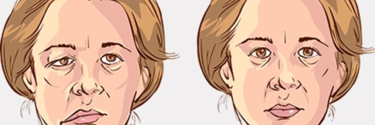 YÜZ FELCİ (PERİFERİK FASİYAL PARALİZİ)