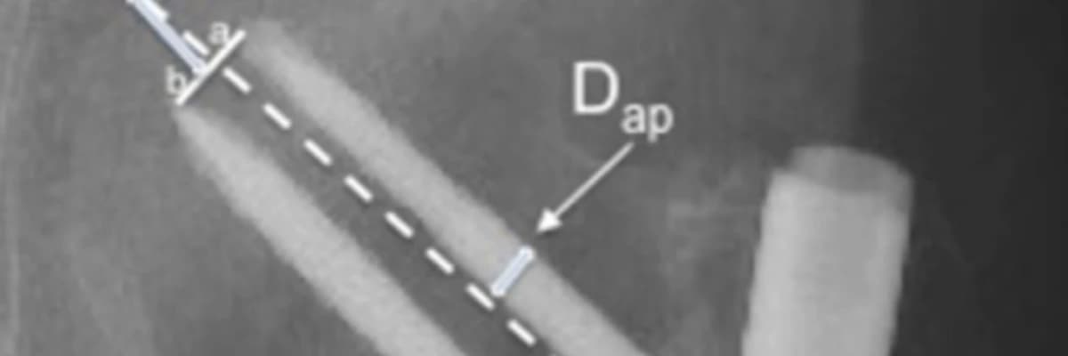 Risk factors for cut-out of double lag screw fixation in proximal femoral fractures