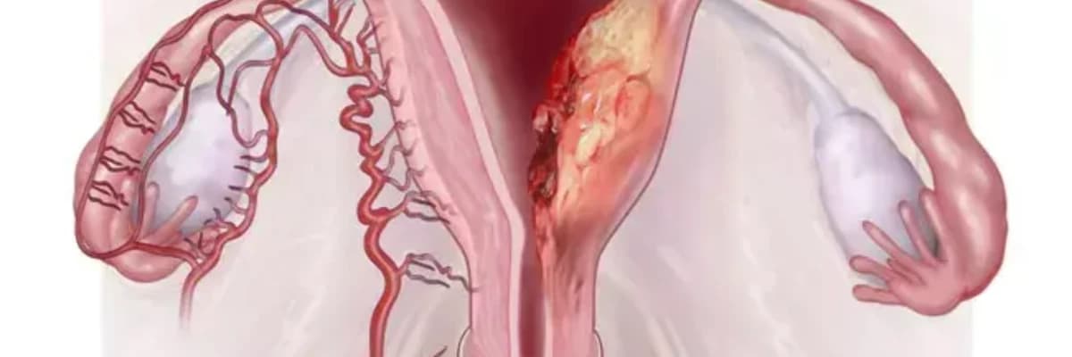 RAHİM KANSERİ TEDAVİSİ