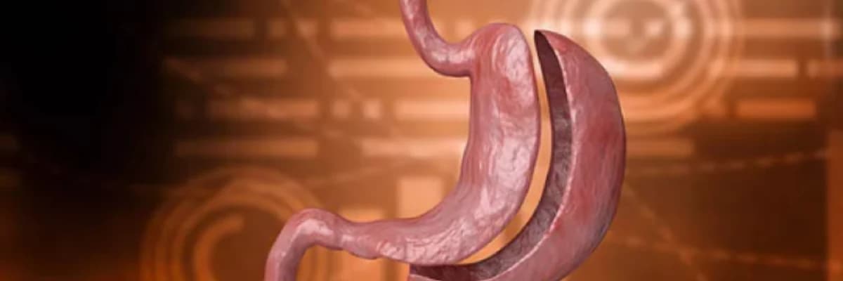 Tüp Mide Ameliyatı