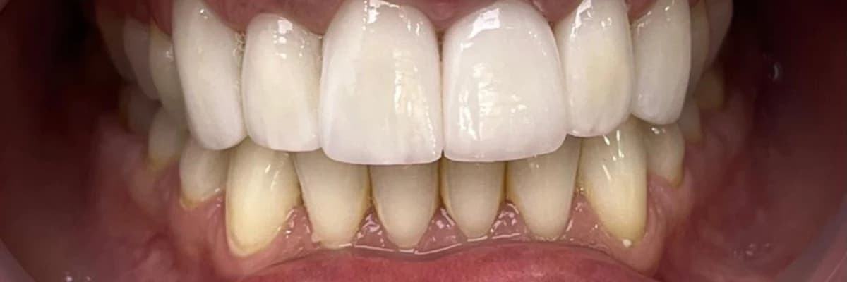 Porselen Lamine Nedir?