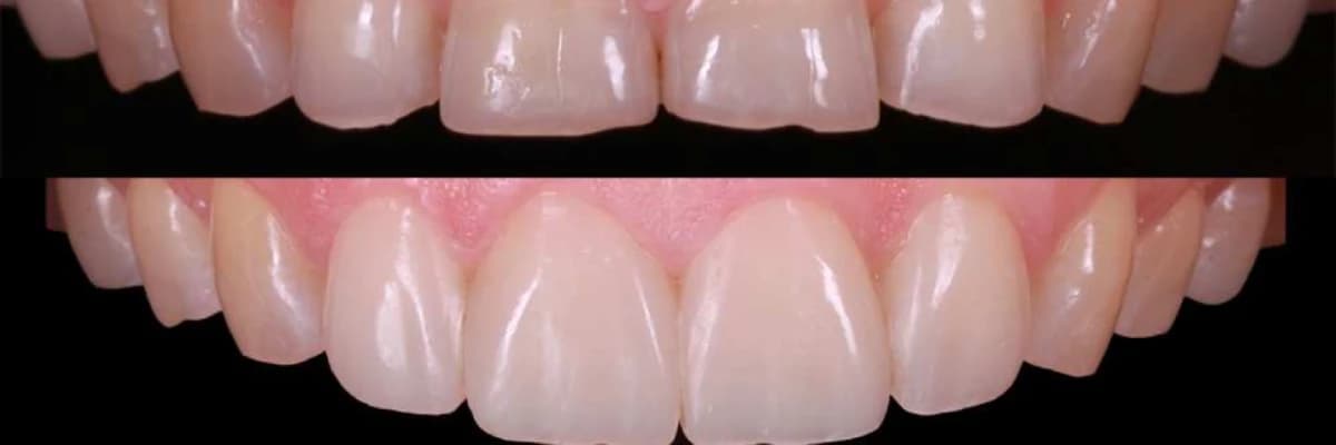 KOMPOZİT LAMİNA (BONDİNG)