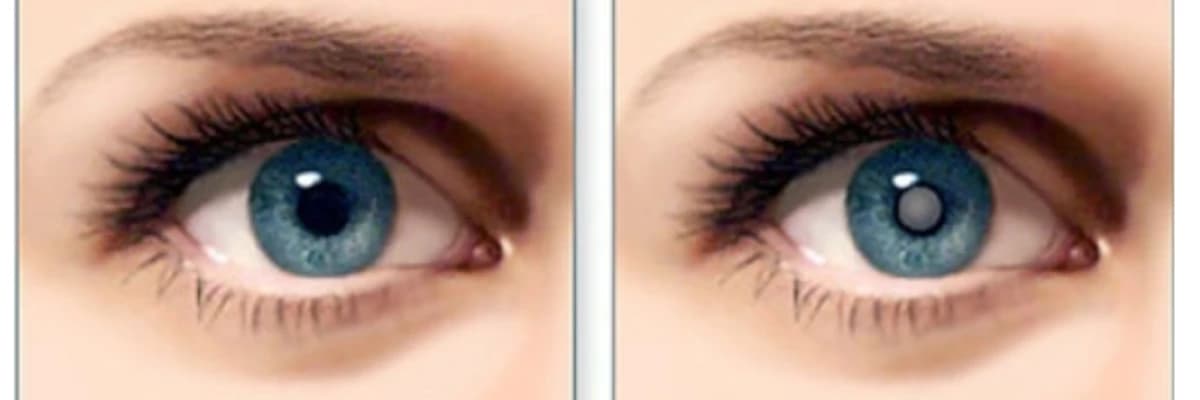 Katarakt nedir? Tedavisi mümkün müdür?