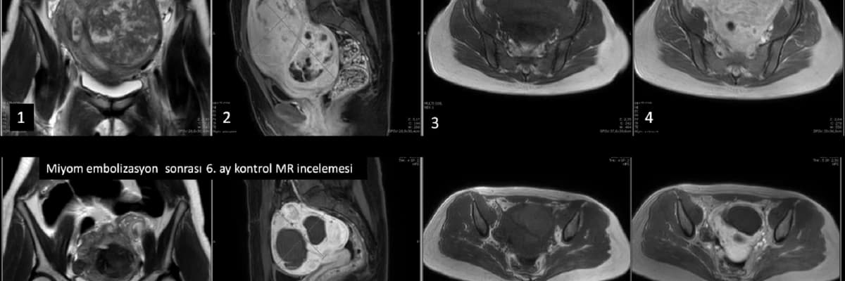 MİYOM EMBOLİZASYONUN DOĞURGANLIĞA ETKİSİ NEDİR?