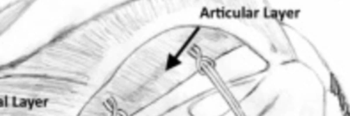 Arthroscopic knotless separate layer transosseous equivalent repair of delaminated rotator cuff tears
