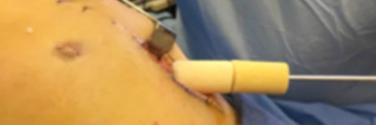 Two-stage revision anterior cruciate ligament reconstruction using allograft bone dowels