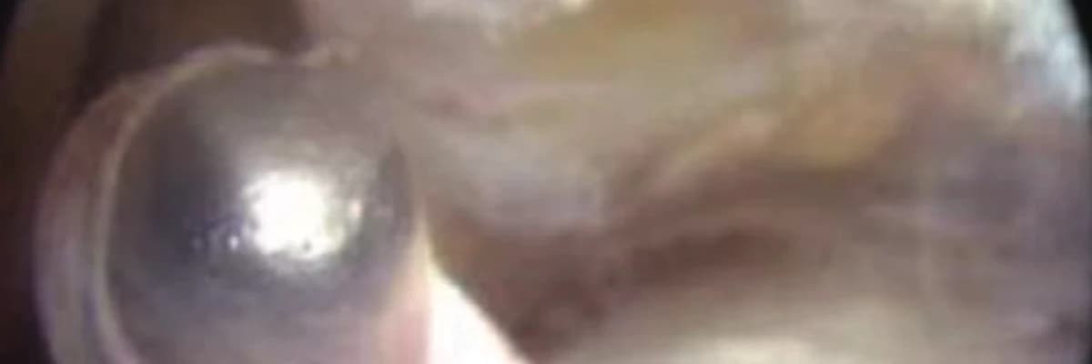 Endoscopy-assisted percutaneous repair of Achilles tendon rupture