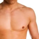 Jinekomasti (erkeklerde meme estetiği)