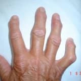 OSTEOARTRİT; KİREÇLENME MECBURİ BİR KADER MİDİR?