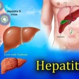 Sinsi Bir Hastalık Hepatitler Siz de Hepatit Hastası mısınız?