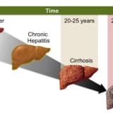 DİSPEPSİ NEDİR? (Şişkinlik, gaz, hazımsızlık)