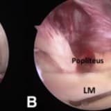 Surgical management of the multiple-ligament knee injury
