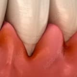 DİŞ ETİ HASTALIKLARI