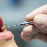 Samsun’da Bademcik Taşı (Tonsillolit) Tedavisi