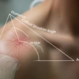 Higher Critical Shoulder Angle has an Increased Risk of Re-Tear After Arthroscopic Rotator Cuff Repair At Long Term Follow-Up