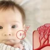 Hemanjiomda Hangi Yöntemi Kullanıyoruz..