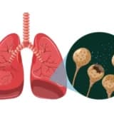 Akciğerinizdeki Küçük Sır: Nodüller Hakkında Merak Ettikleriniz