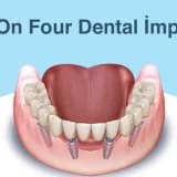 All On Four İmplant Sistemleri