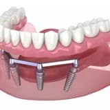 Hassas bağlantılı (Çıtçıtlı protez) nedir?