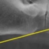 Assessment of Calcaneal Morphology and Radiological Parameters in Haglund’s Syndrome