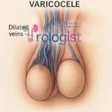 VARİKOSEL NEDİR? | TEŞHİS VE TEDAVİ | KISIRLIKLA İLİŞKİSİ?