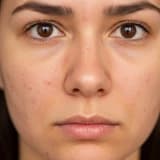 Hamilelikte yaşanan cilt sorunları nelerdir?