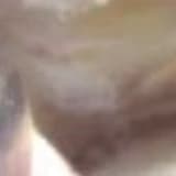 Endoscopy-assisted percutaneous repair of Achilles tendon rupture