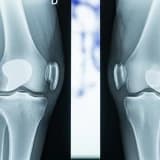Çimentolu ve Çimentosuz Oxford Unikondiler Diz Artroplastilerinde Radyolusent Hatların Karşılaştırılması: Tasarımcı Olmayan Bir Grup Raporu